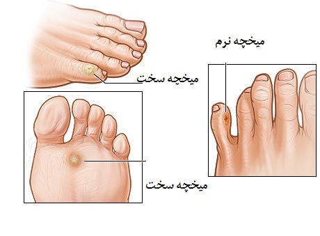 Calluses-and-corns-investigation